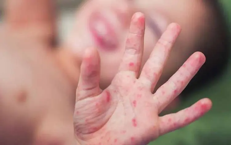 The Ministry of Health announces the detection of new cases of measles disease