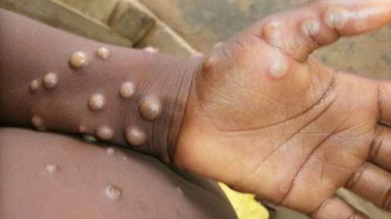 Medical Warning: Monkeypox is out of control
