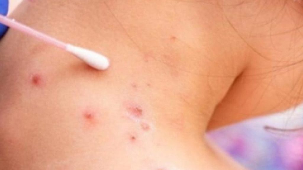 The first case of monkeypox in Morocco… a report from the Ministry of Health