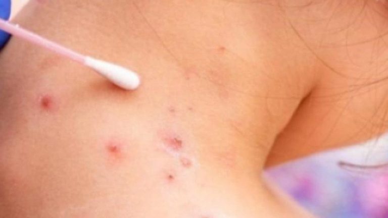 The first case of monkeypox in Morocco… a report from the Ministry of Health