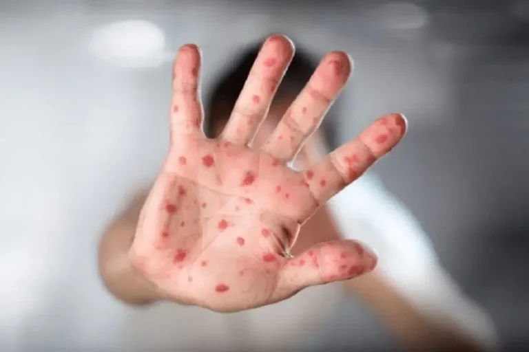 The first case of monkeypox was recorded in the city of Marrakech