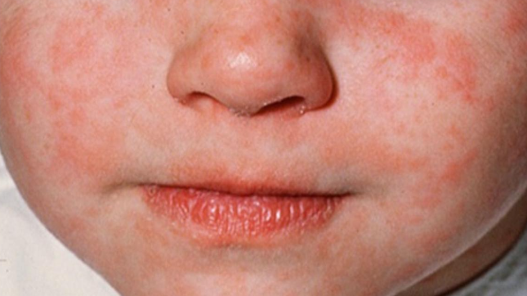 More than 19 thousand infections and 107 deaths. Health Minister reveals details of “Bouhédroun” disease epidemic