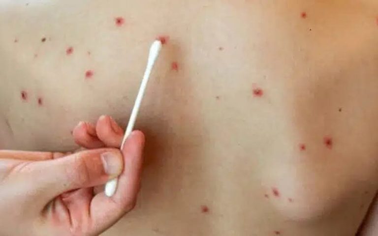 4 cases of “Bouhédroun” disease recorded in Tangier prison