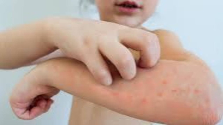 The Directorate of Education in Settat highlights the need for vaccination in the face of “Bou Hamroun”